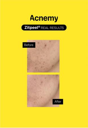 Відлущуючий скраб — Acnemy Zitpeel