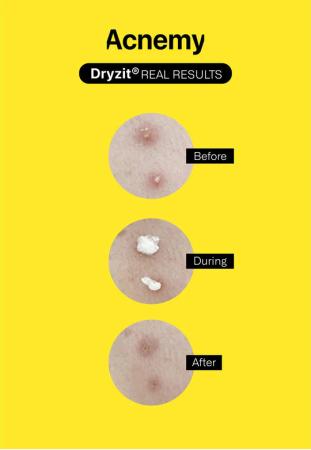 Підсушуючий лосьйон для проблемної шкіри — Acnemy Dryzit